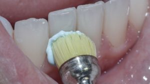 O que é profilaxia dentária e quais são seus benefícios?