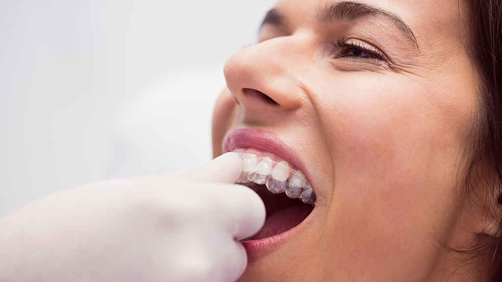 Ortodontia em adultos: por que você deve considerar usar alinhadores  transparentes? - Clínica Abla Odontologia